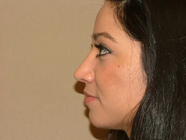 Rhinoplasty Patient 06 After 1