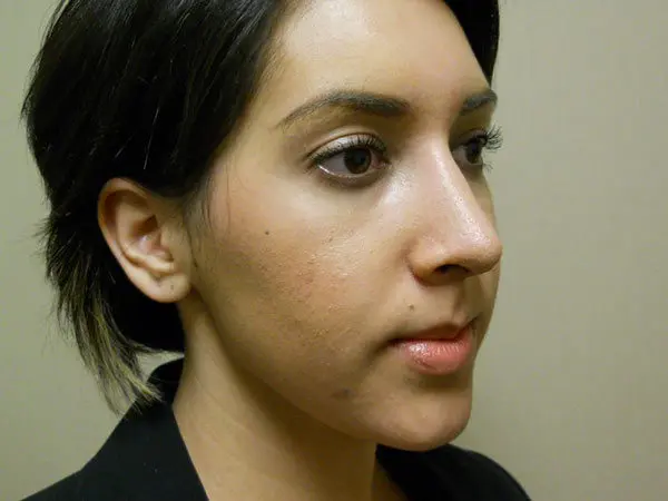 Rhinoplasty Patient 22 After 2