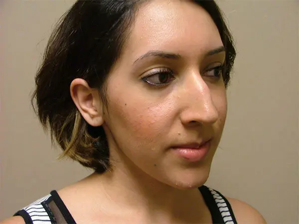 Rhinoplasty Patient 22 Before 2