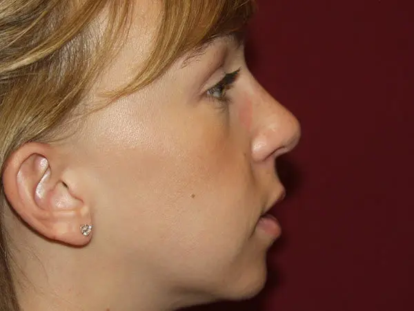 Rhinoplasty Patient 24 After 2