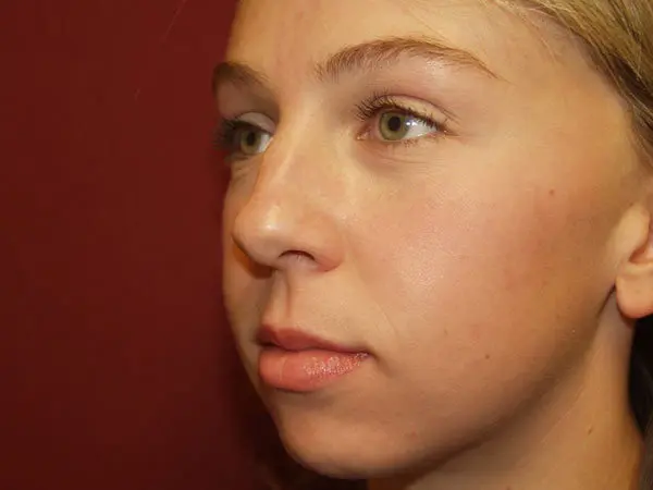 Rhinoplasty Patient 24 Before 1