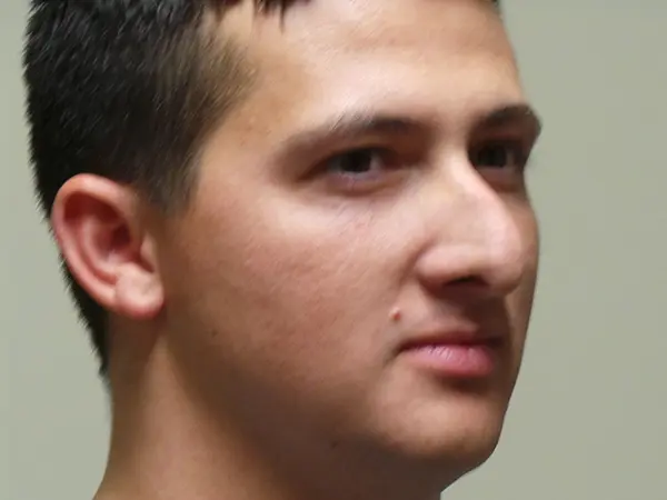 Rhinoplasty Patient 49 Before 1