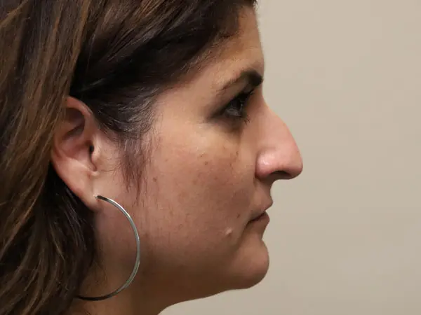 Rhinoplasty Patient 50 Before 2