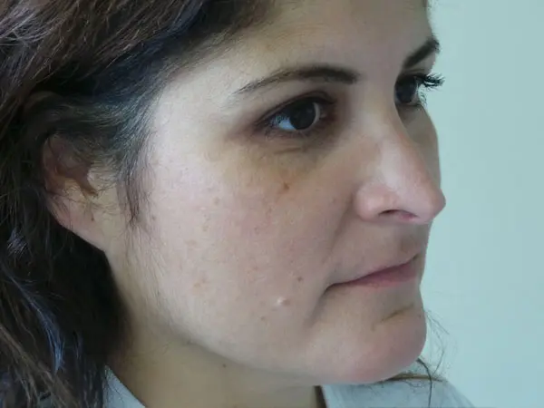 Rhinoplasty Patient 50 After 1