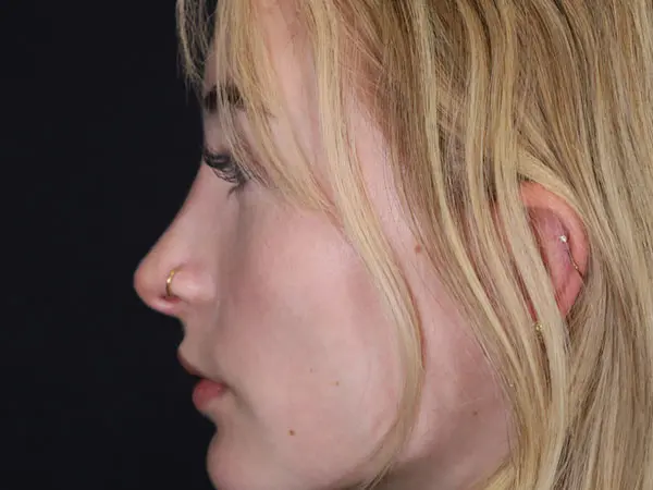 Rhinoplasty Patient 51 After 2