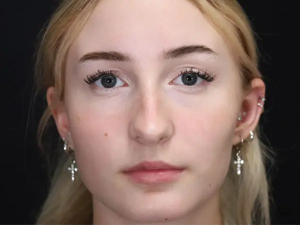 Rhinoplasty Patient 51 Before 3