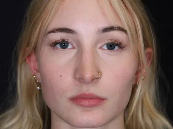 Rhinoplasty Patient 51 After 3