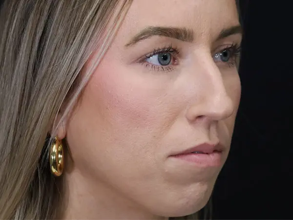 Rhinoplasty Patient 52 Before 1