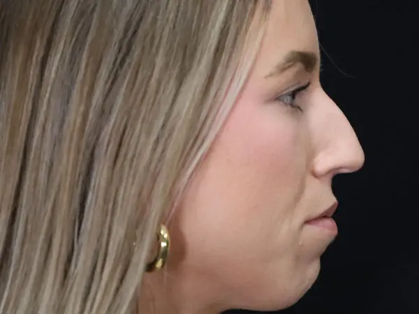 Rhinoplasty Patient 52 Before 2
