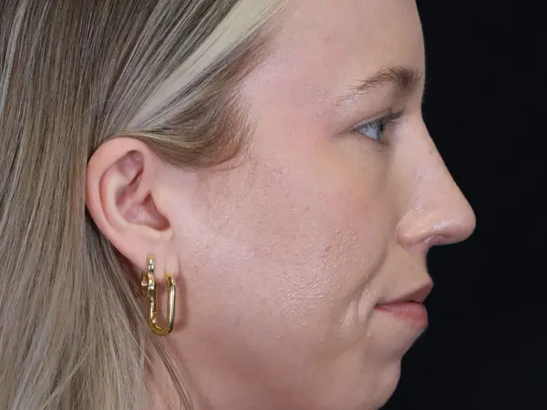 Rhinoplasty Patient 52 After 2