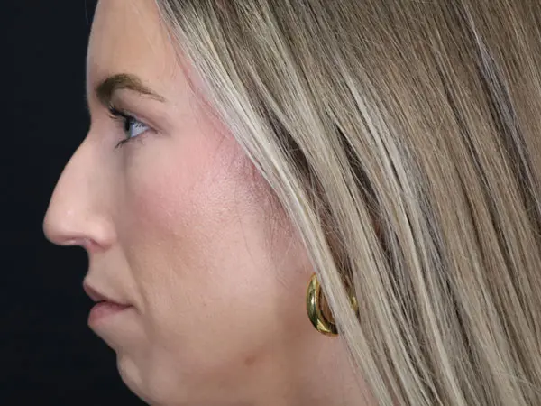 Rhinoplasty Patient 52 Before 3