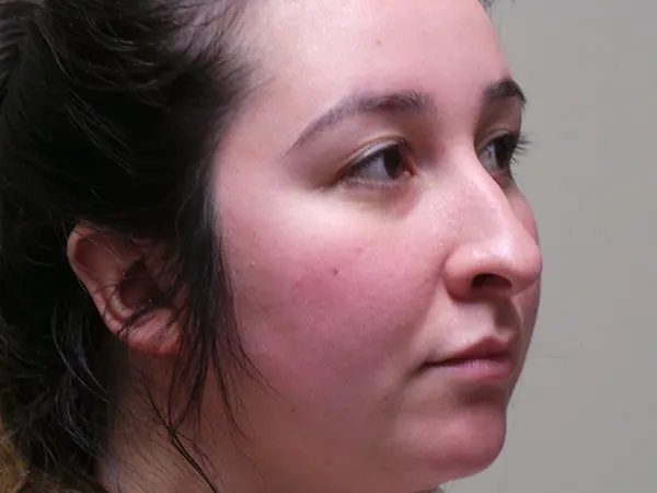 Rhinoplasty Patient 44 Before 2
