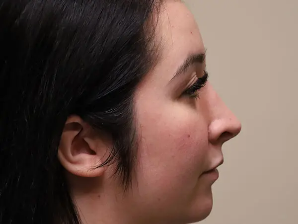 Rhinoplasty Patient 44 After 1