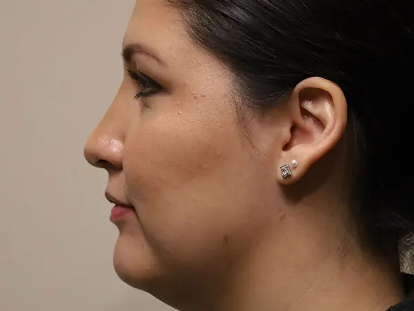 Rhinoplasty Patient 45 After 1