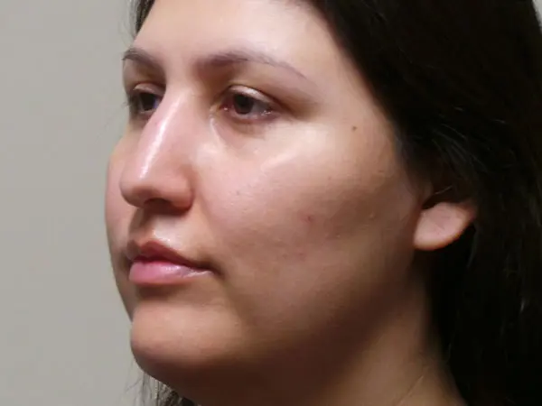 Rhinoplasty Patient 45 Before 2