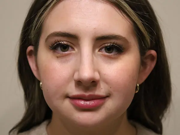 Rhinoplasty Patient 46 After 3