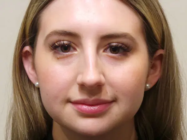 Rhinoplasty Patient 46 Before 3