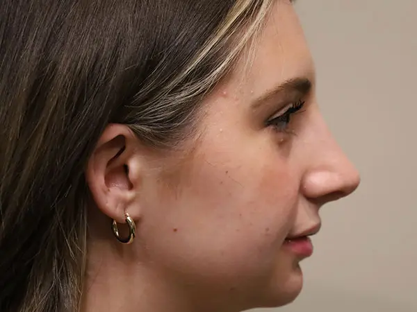 Rhinoplasty Patient 46 After 1