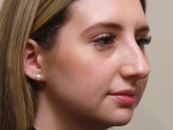 Rhinoplasty Patient 46 Before 2