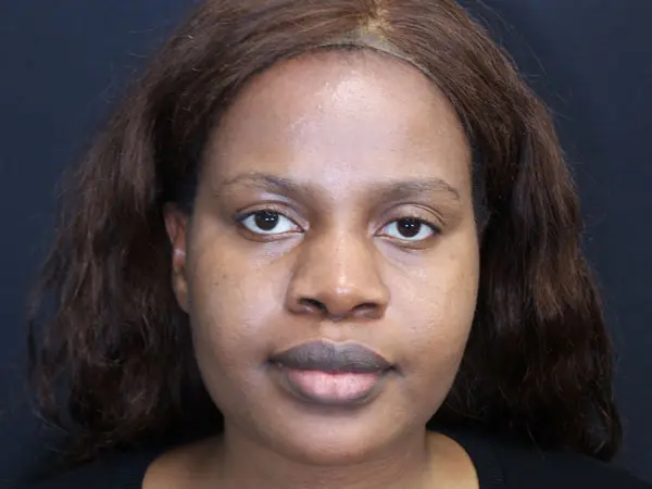 Rhinoplasty Case 53 Before 1