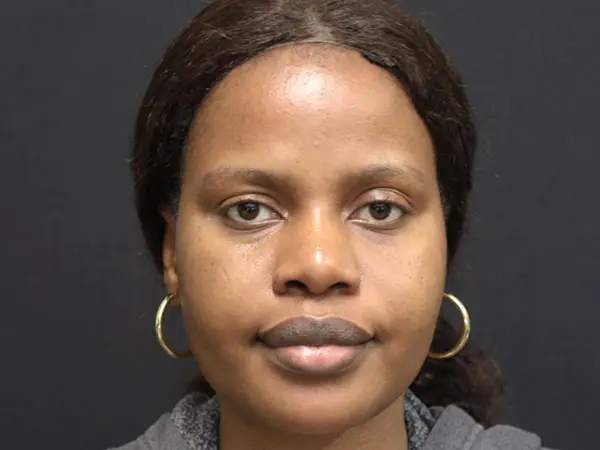 Rhinoplasty Case 53 After 1