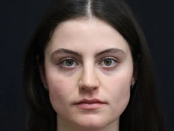 Rhinoplasty Case 54 After 1