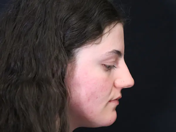 Rhinoplasty Case 54 Before 2