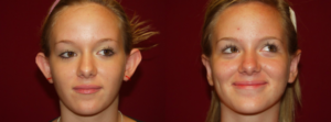 Otoplasty Before and After Photos