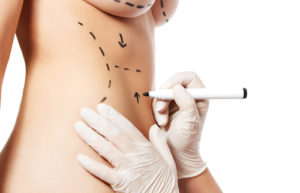 Woman body marked out for cosmetic surgery