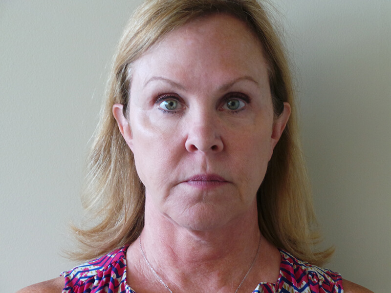 Facelift Patient Before