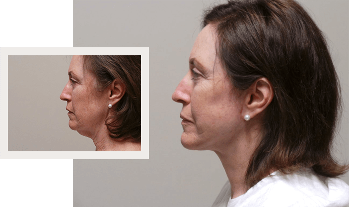 Before and After - Facelift Surgery