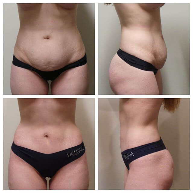 Before and After - Tummy Tuck Surgery