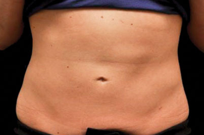 Coolsculpting® Patient After