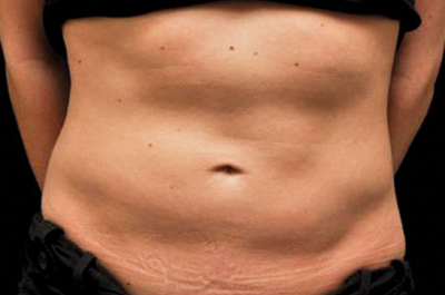 Coolsculpting® Patient Before