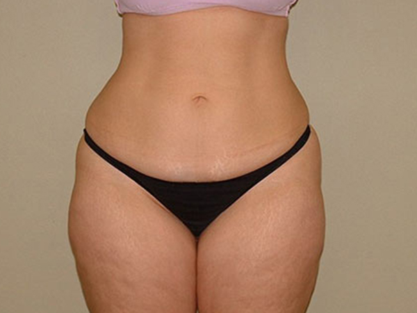 Liposuction Patient Before