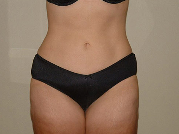 Liposuction Patient After