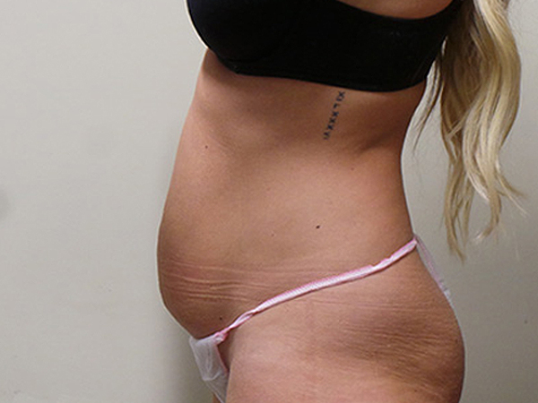 Tummy Tuck Patient 22 Before 2