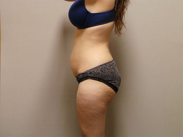 Tummy Tuck Patient 01 Before 2