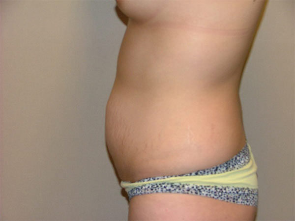 Tummy Tuck Patient 15 Before 2