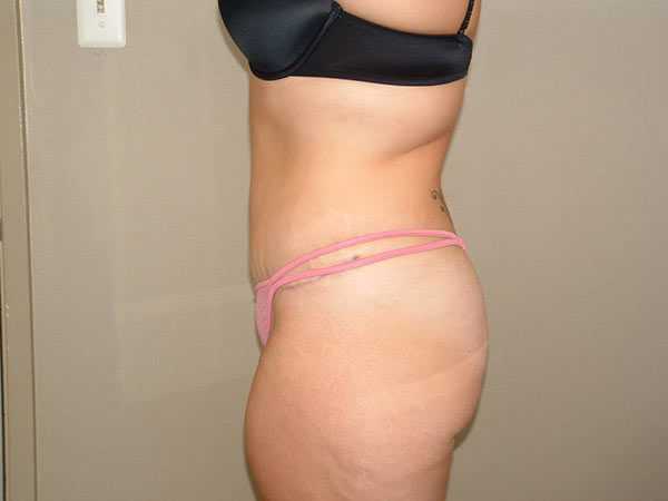 Tummy Tuck Patient 21 After 2