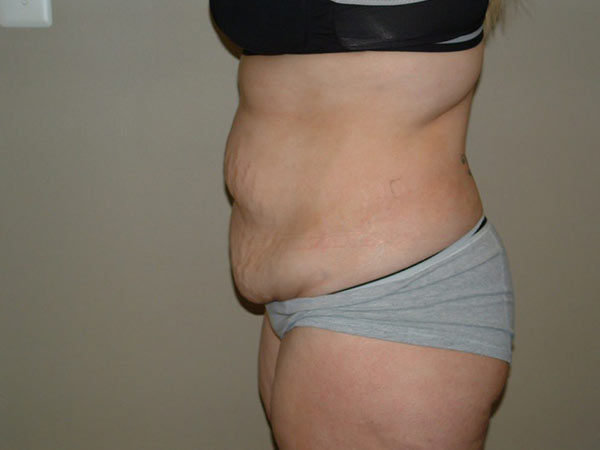 Tummy Tuck Patient 21 Before 2