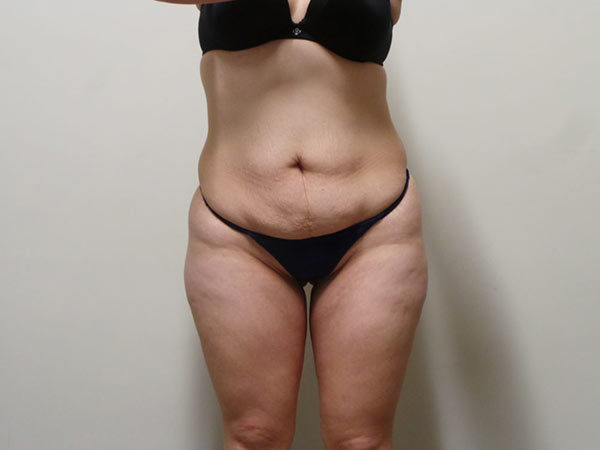 Tummy Tuck Patient 02 Before 1