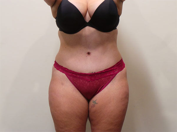 Drainless Tummy Tuck (Abdominoplasty) Patient After