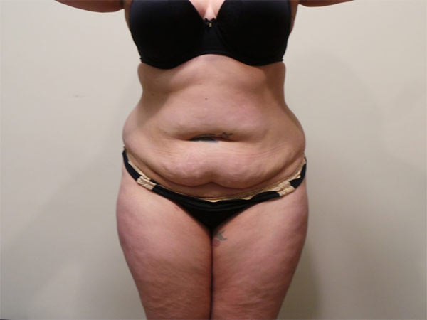 Drainless Tummy Tuck (Abdominoplasty) Patient Before