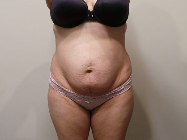 Tummy Tuck Patient 04 Before 1