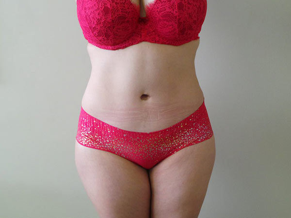 Tummy Tuck Patient 06 After 1