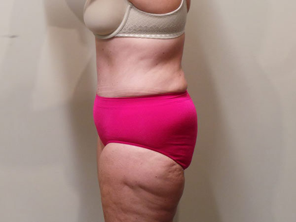 Tummy Tuck Patient 07 After 2