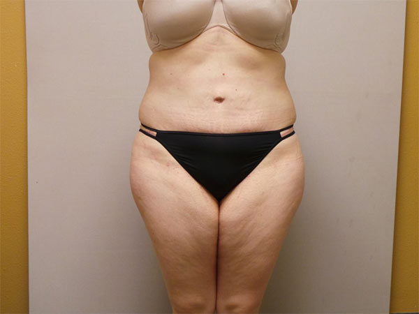Tummy Tuck Patient 08 After 1