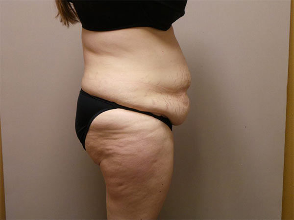 Tummy Tuck Patient 08 Before 2