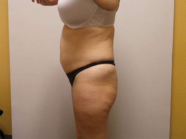 Tummy Tuck Patient 09 Before 2